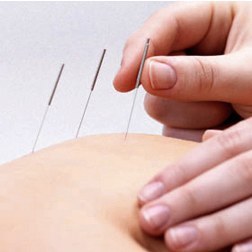 acupuncture