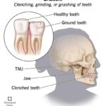 Teeth Clenching Bruxism
