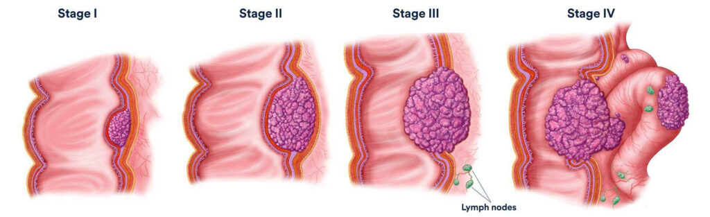 Massage Therapy Center Colon Cancer Stages