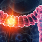 Massage Therapy Center Colorectal Cance Banner Pr