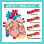 Palo Alto Massage Therapy Center Heart Attack