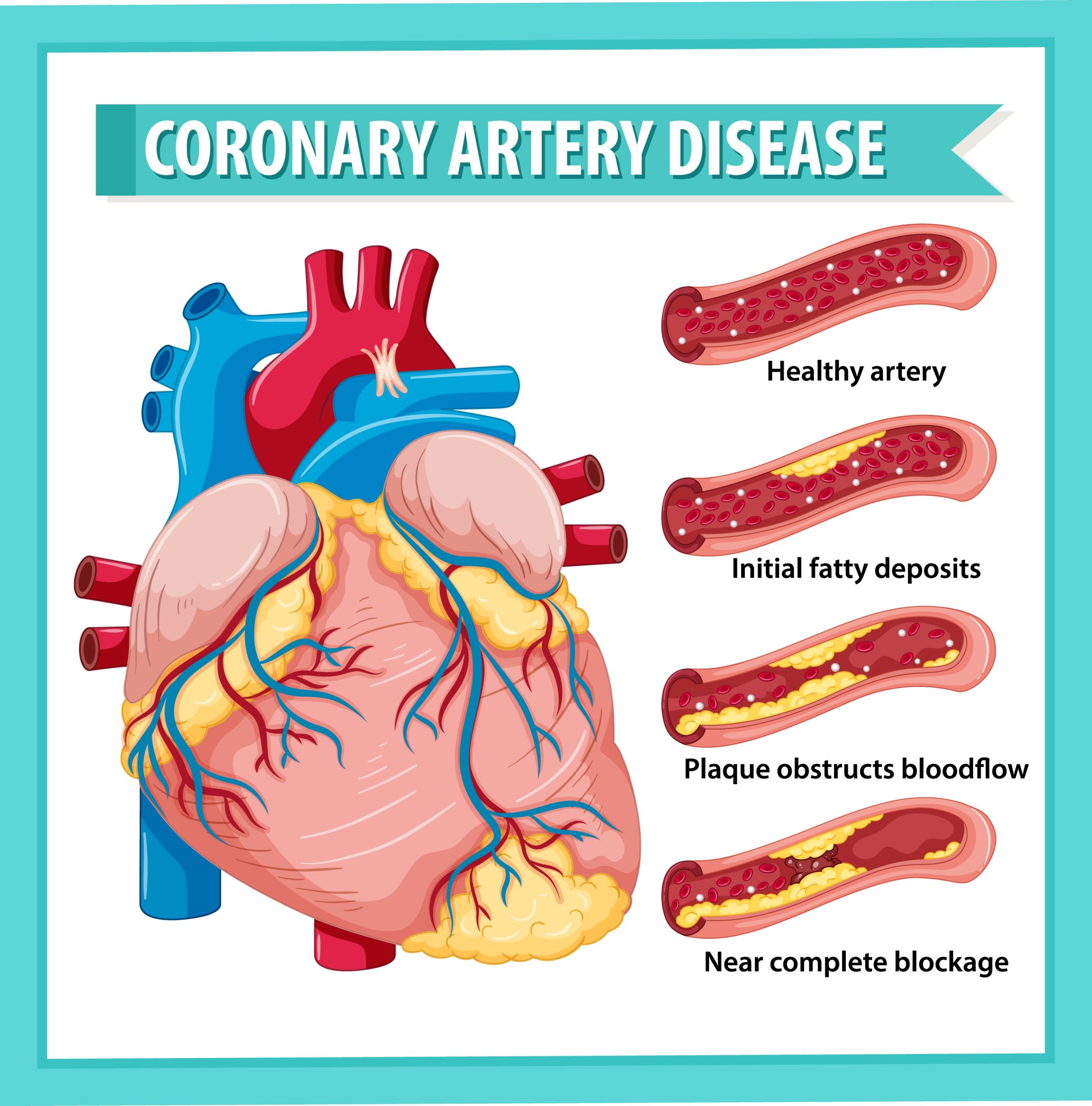 Palo Alto Massage Therapy Center Heart Attack